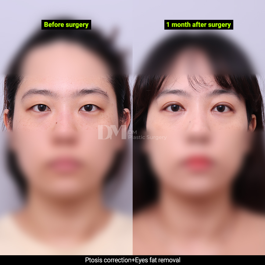 /images/en/Eyes_EyesSurgery/plastic surgery in korea_eyes surgeryBA11.jpg